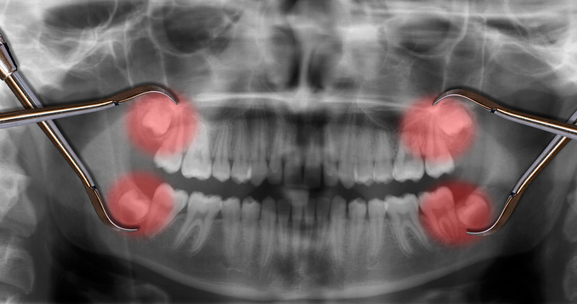X ray of impacted Wisdom Teeth in Denton TX
