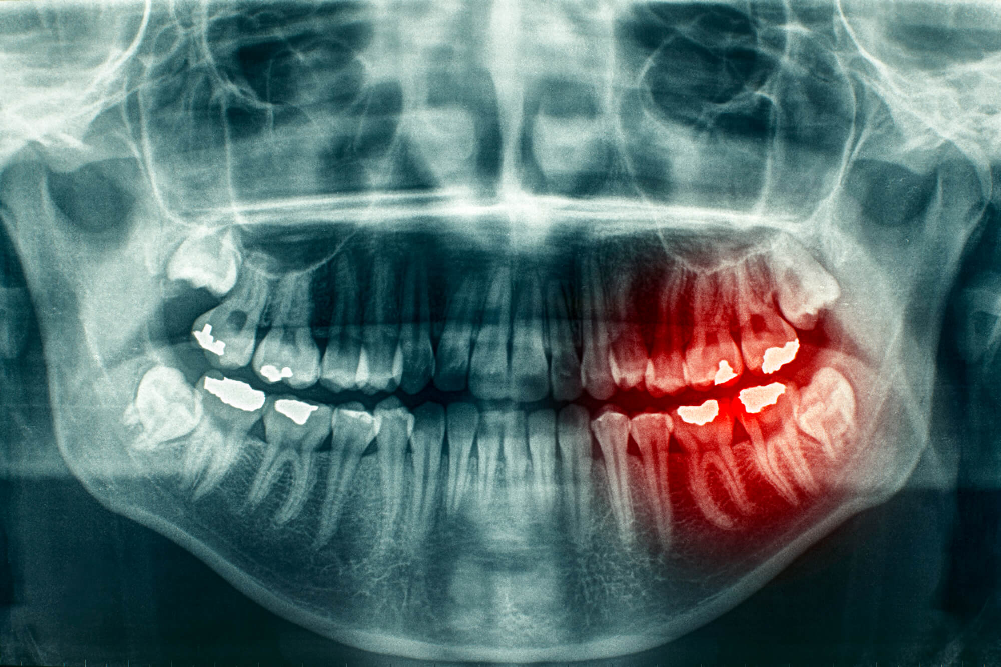 X ray of painful teeth taken by Oral Surgeon 76210