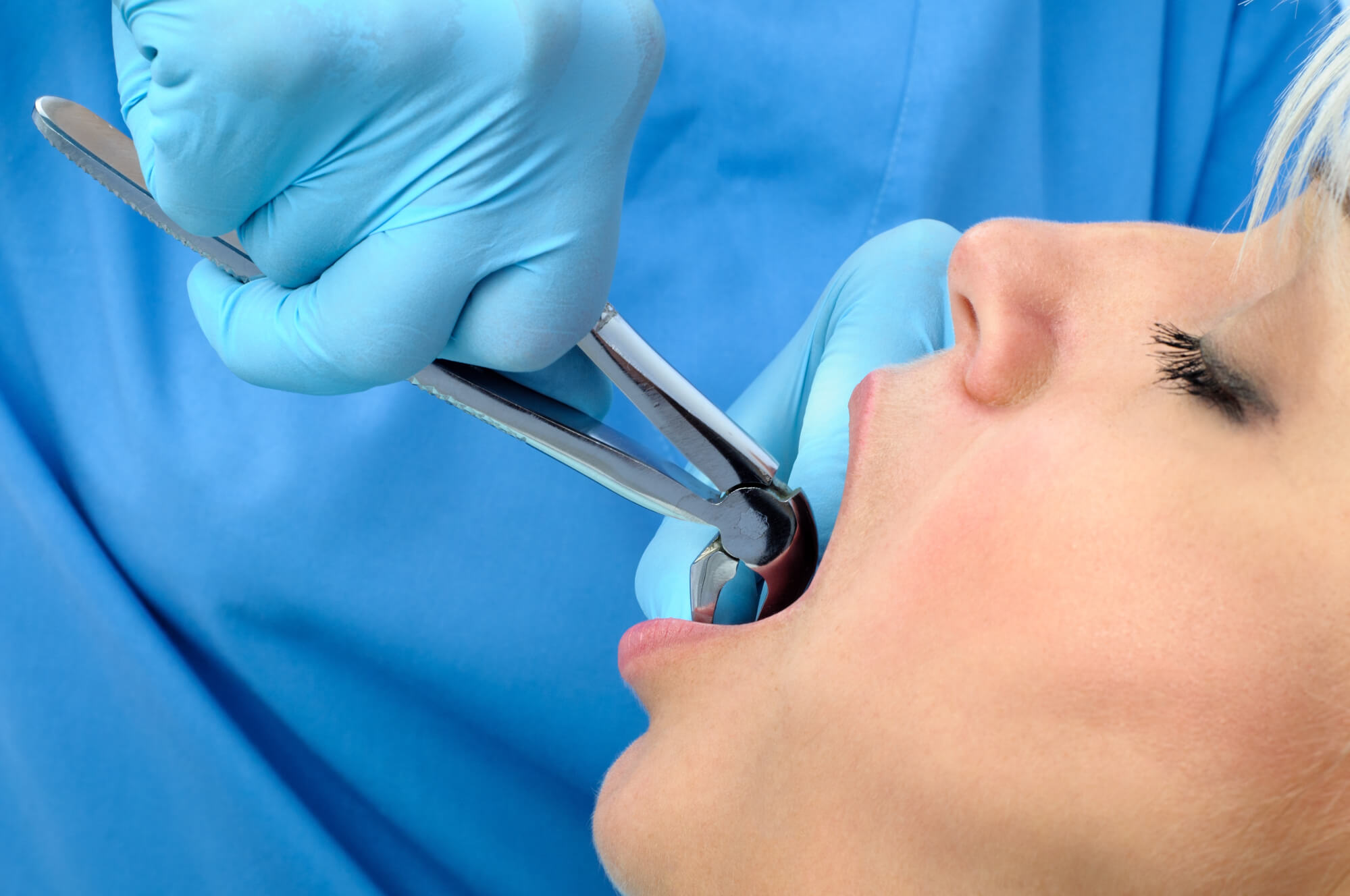 Closeup of a patient getting teeth Extractions 76210
