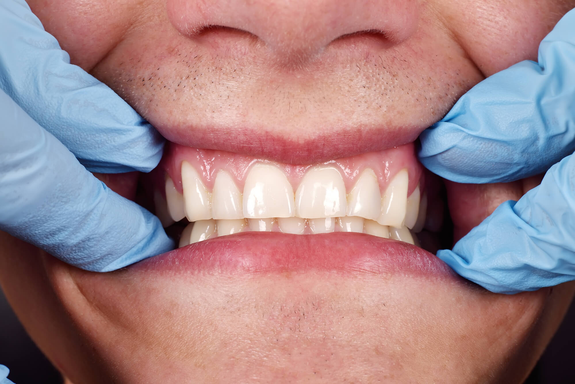 Closeup of dentist showing patient's teeth after Surgical Dental Implants in Plano