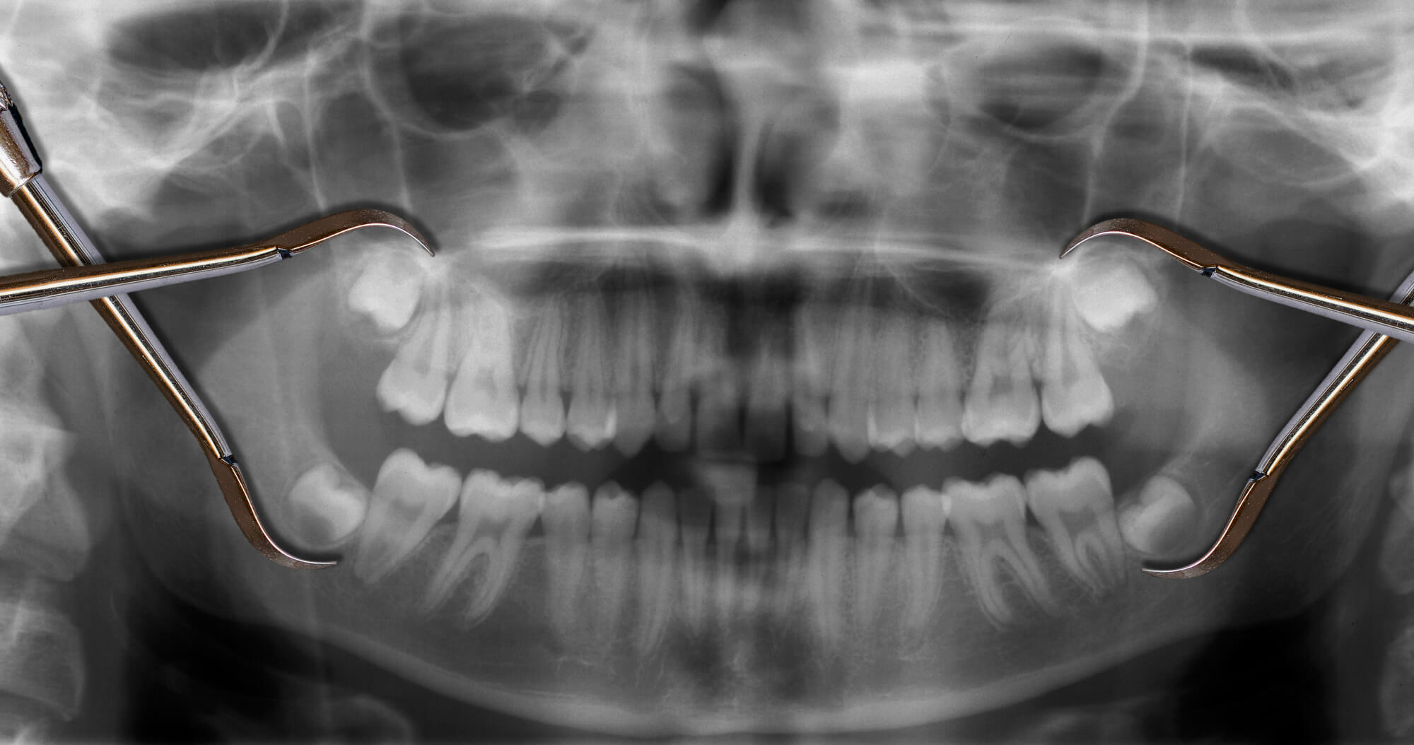 Xray of Impacted Wisdom Teeth at 76210 