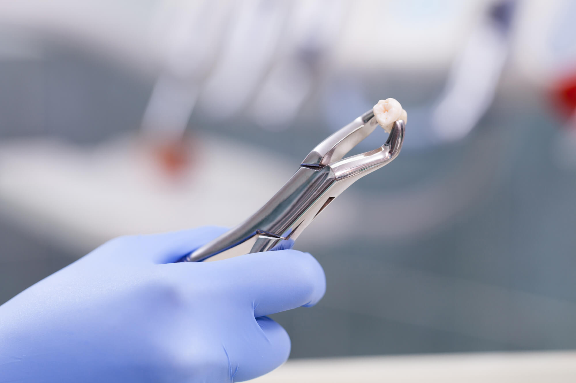 Successful tooth extractions in 76210