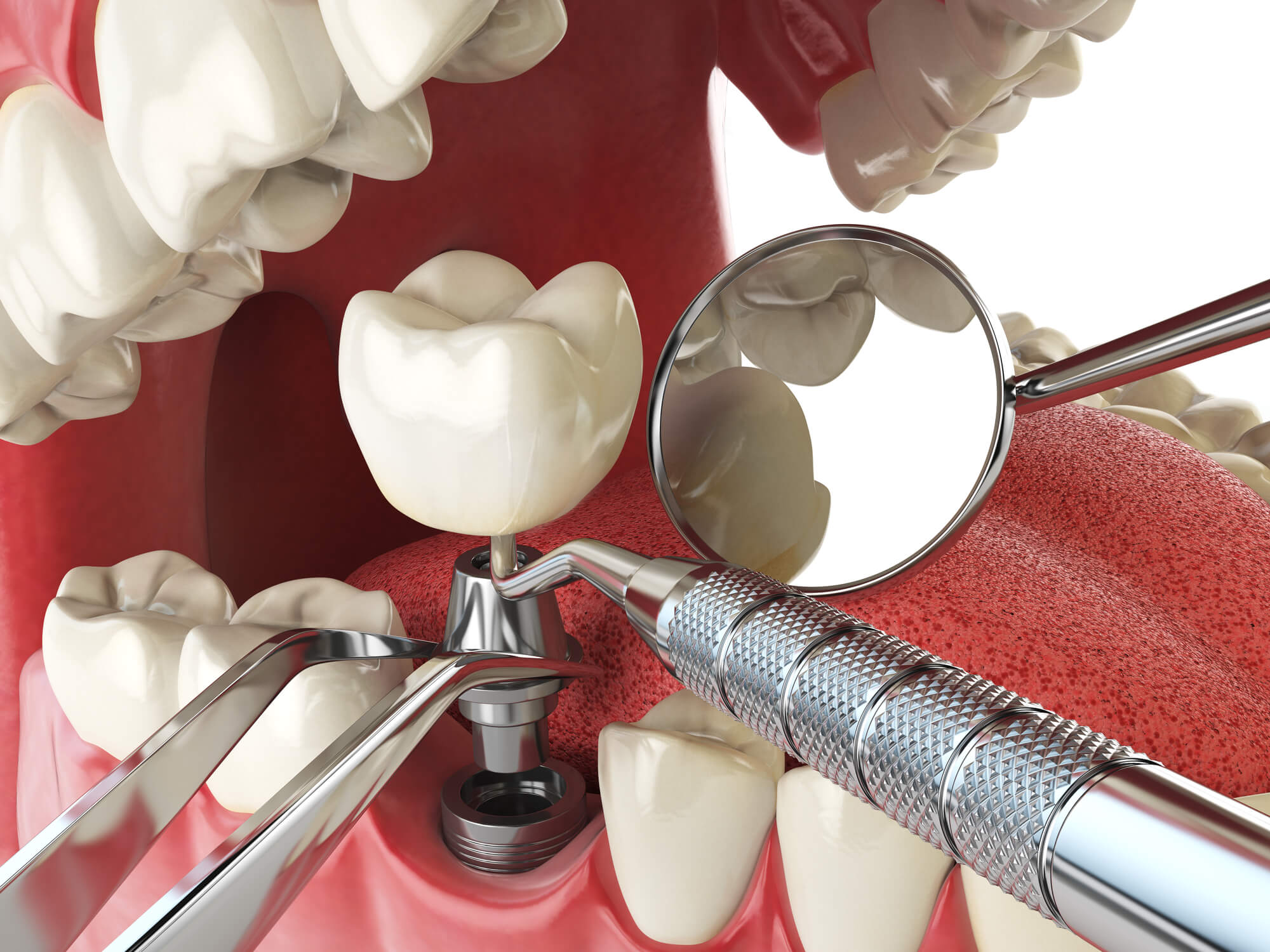 illustration of Dental Implants in Denton