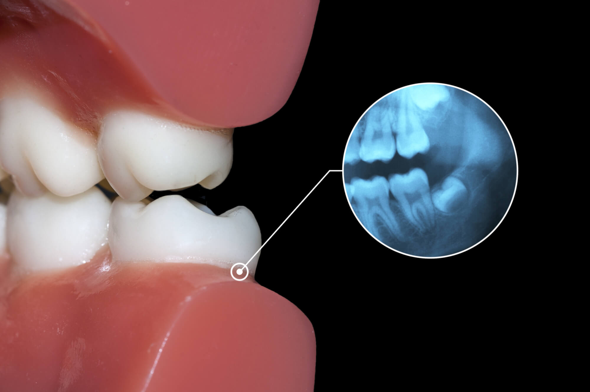 impacted wisdom tooth needing Wisdom Teeth Removal 76210