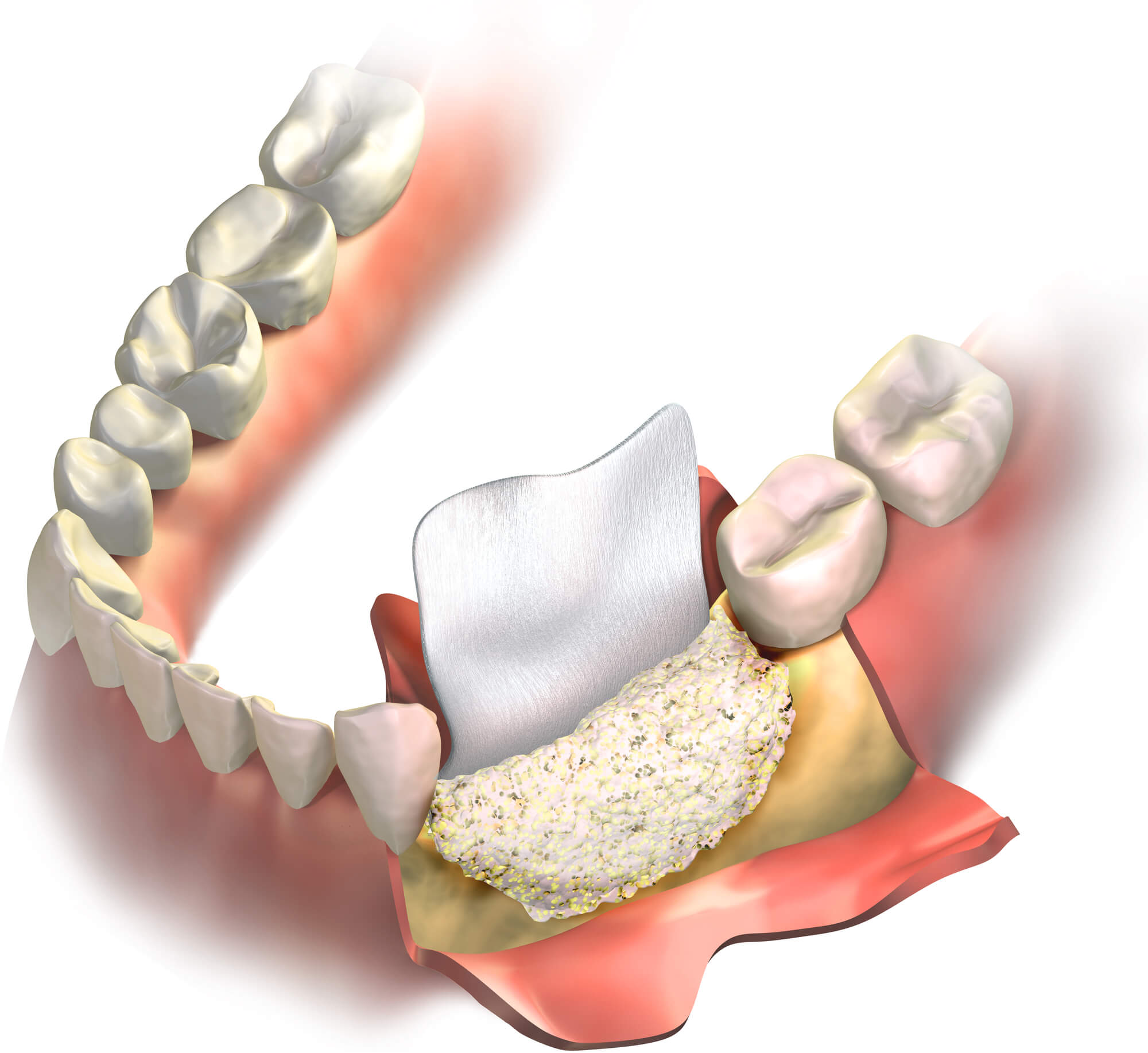 3D illustration of a Bone grafting procedure in 76210