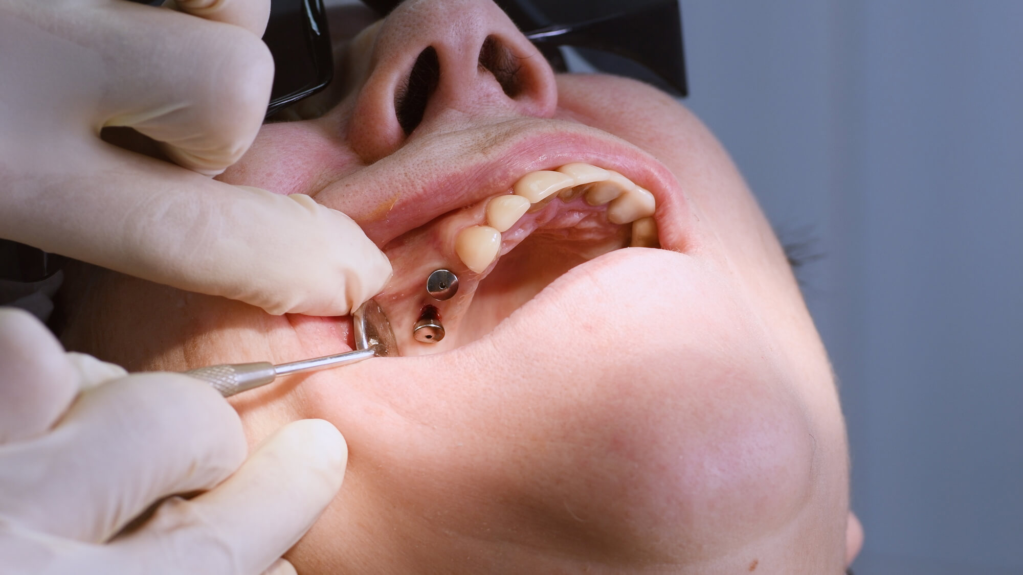 oral surgeon in Plano checking a patient's dental implants