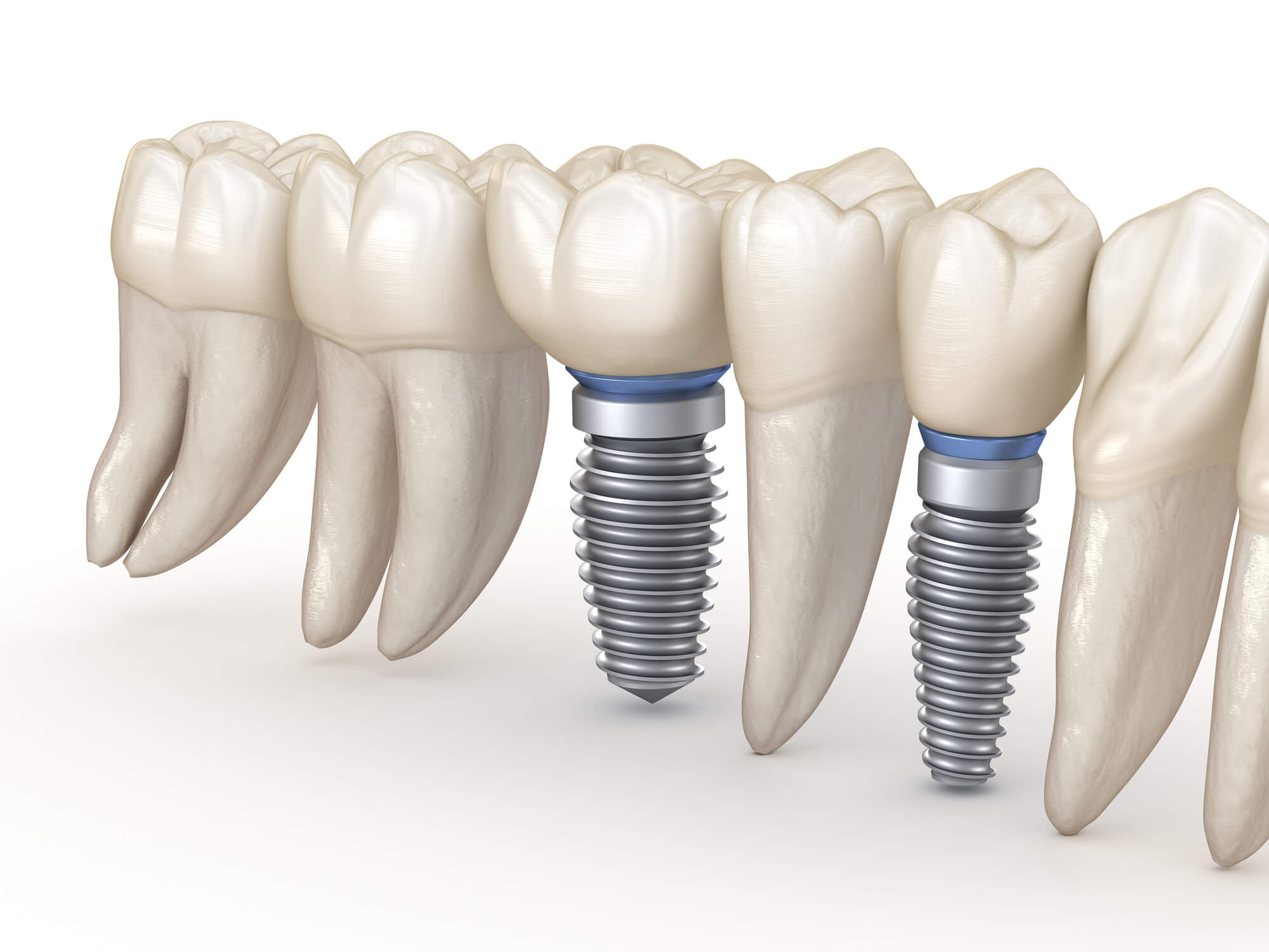 illustration of dental implants in Decatur