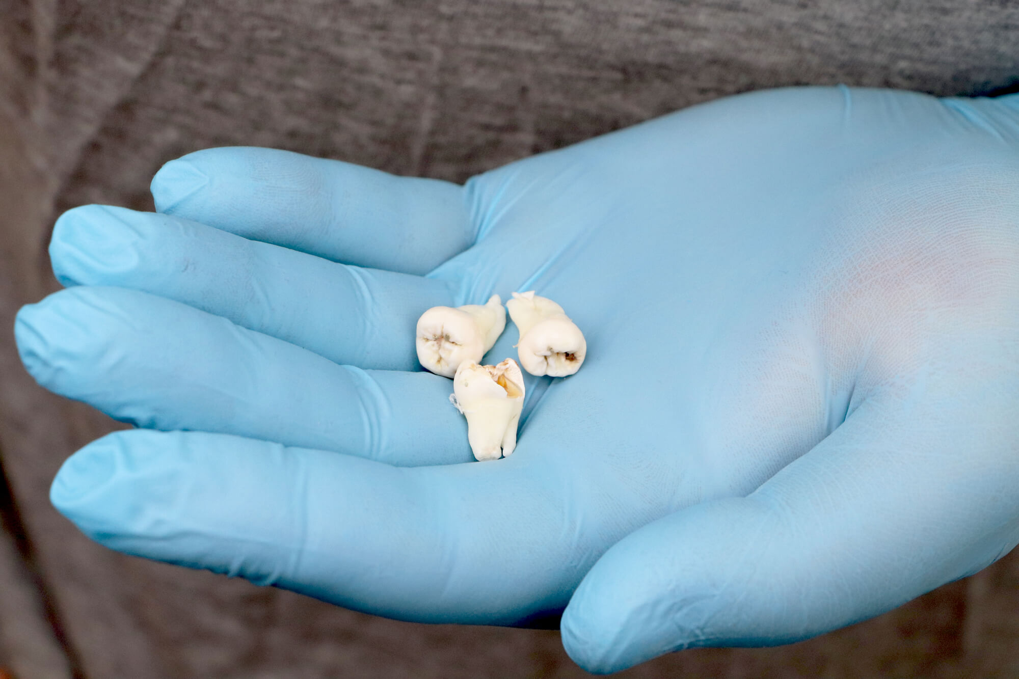 extracted Impacted wisdom teeth 76210