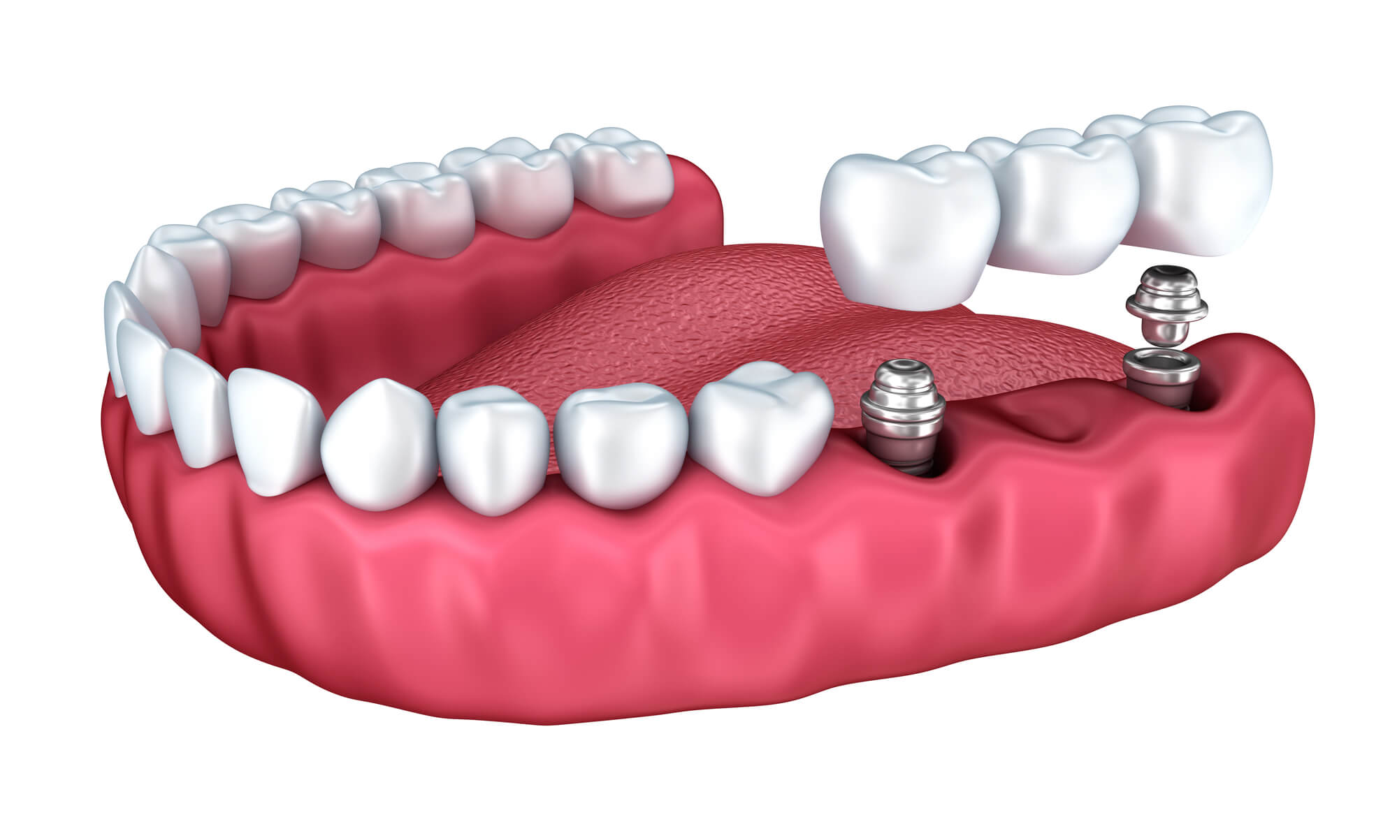 illustration of dental implants in Denton