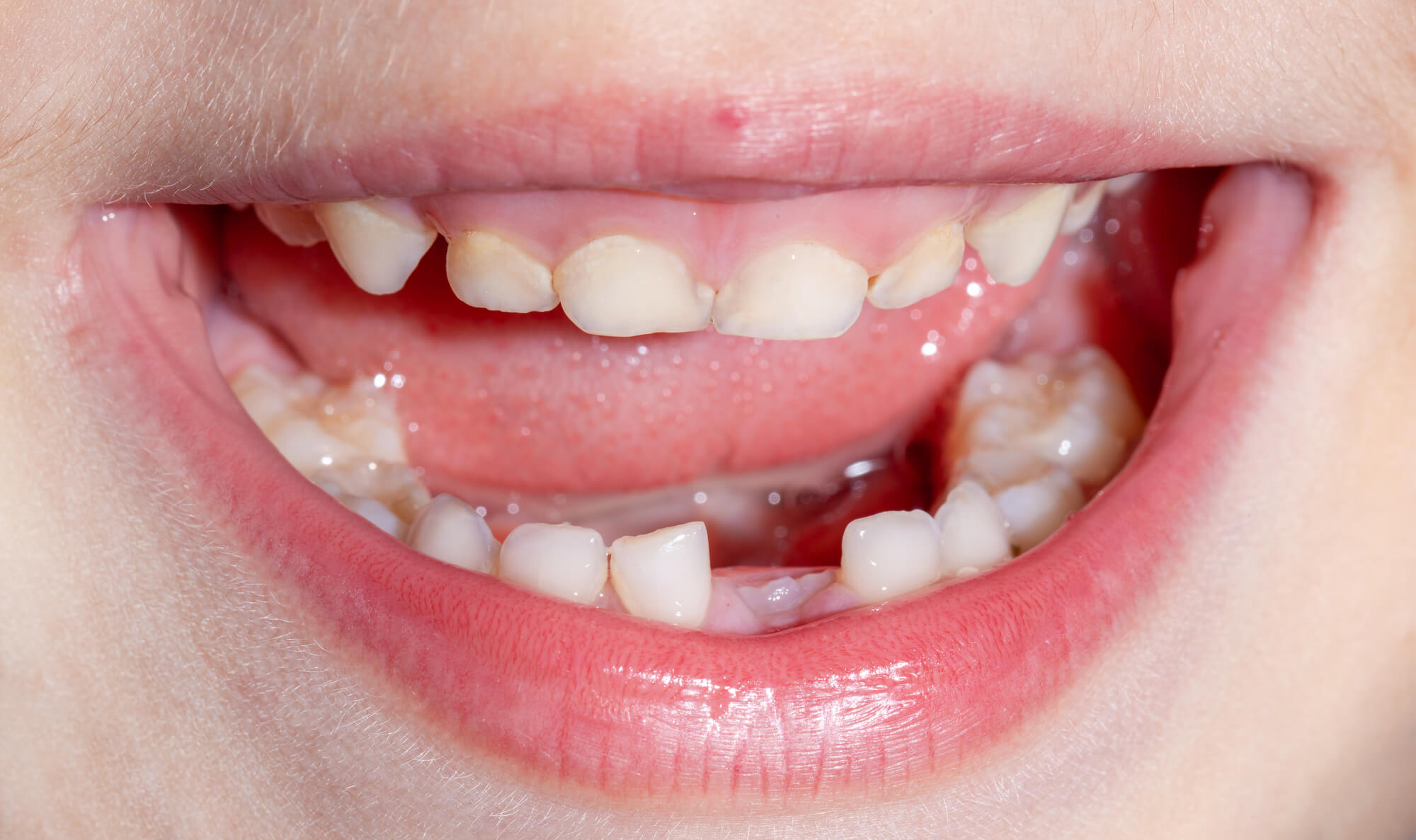 missing tooth because of tooth extraction in Denton