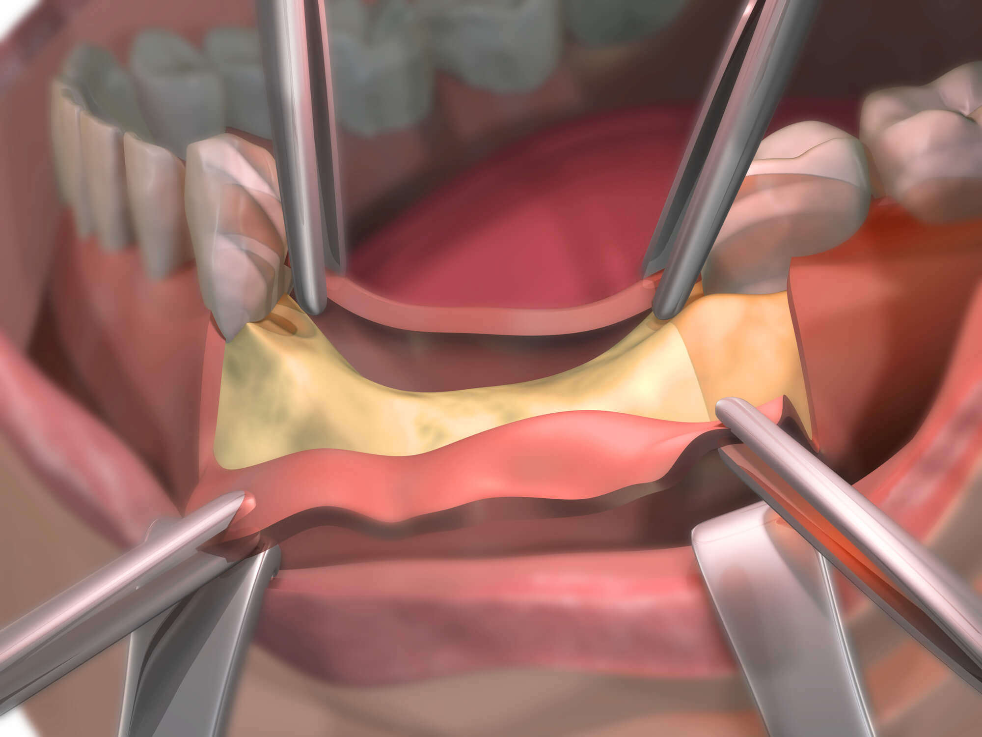 Bone grafting procedure 76210