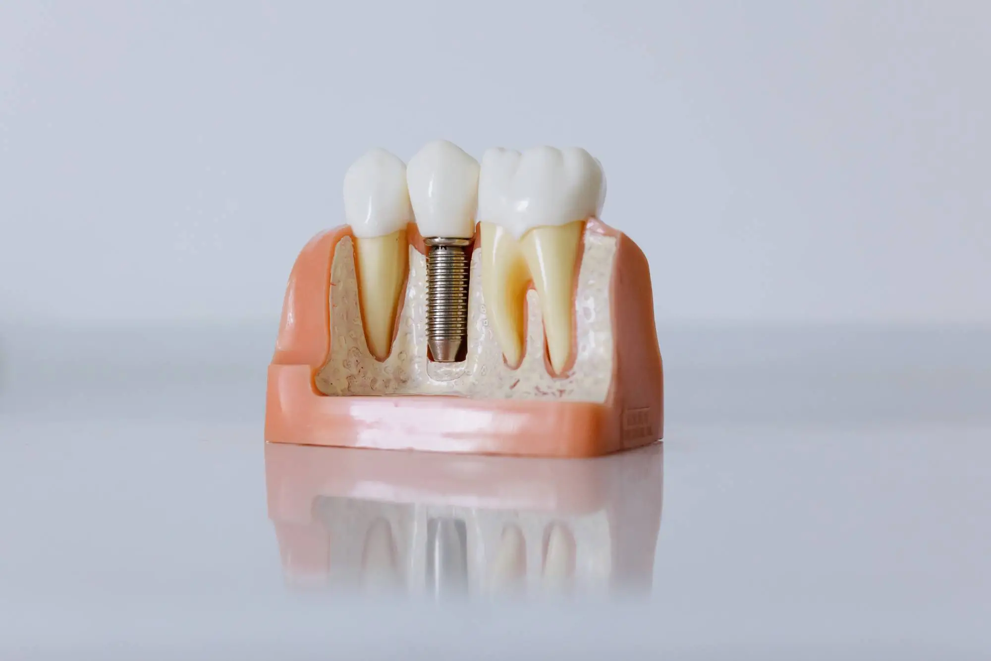 Dental Implant Image Dental Implant Image
