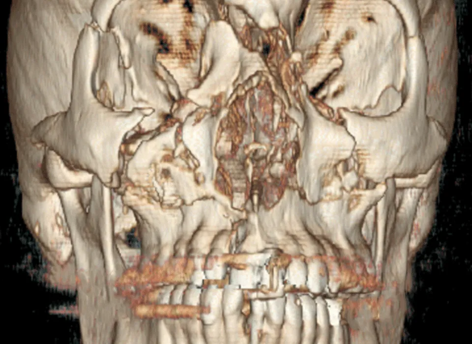 Facial Trauma Image