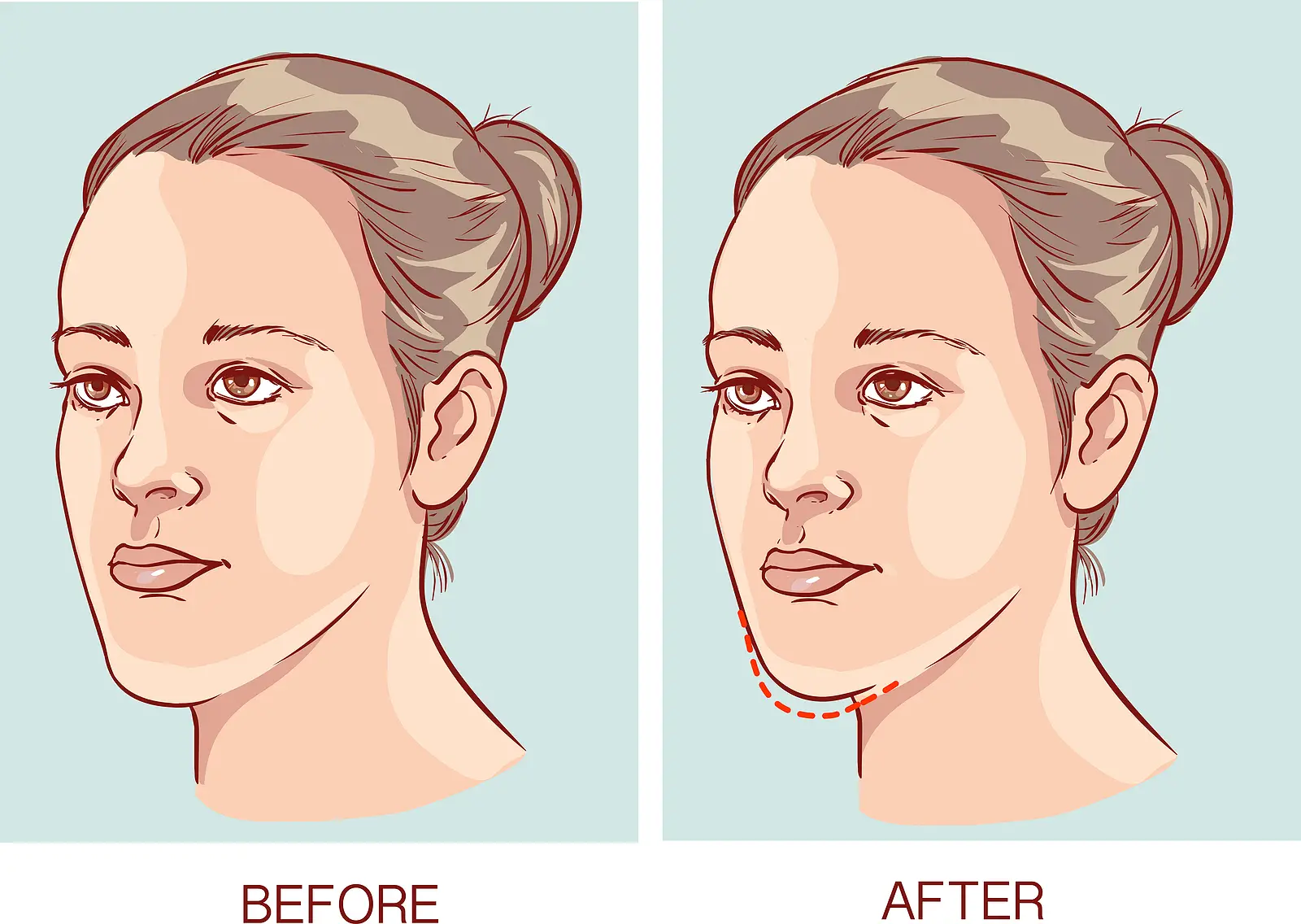 Jaw Surgery Image